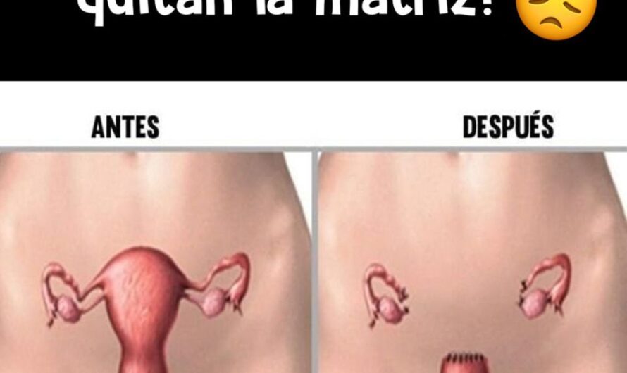 Entérate que sucede en tu cuerpo cuando te sacan la matriz o útero