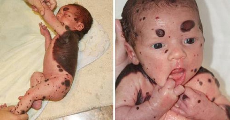 Una madre llora de tristeza : su bebé nació con manchas negras
