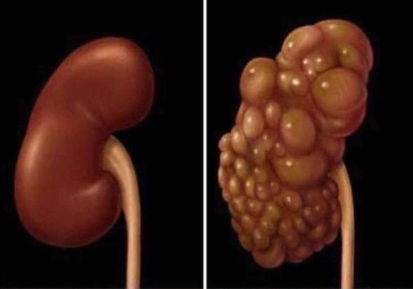SI SUS RIÑONES ESTÁN EN PELIGRO EL CUERPO LE DARÁ ESTAS SEÑALES, PONGA MUCHA ATENCIÓN