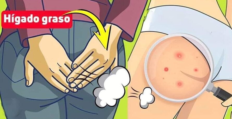 SEÑALES QUE TU HÍGADO MANDA CUÁNDO ESTÁ ENFERMO